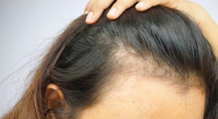 ¿Qué es la alopecia femenina?